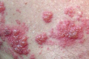 Fucoidan Increased Risk of Stroke Found In Seniors With Shingles