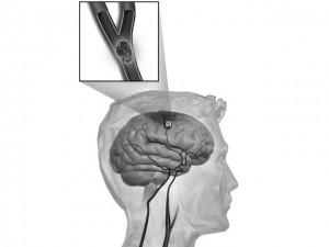 Fucoidan and the brain stroke impairment